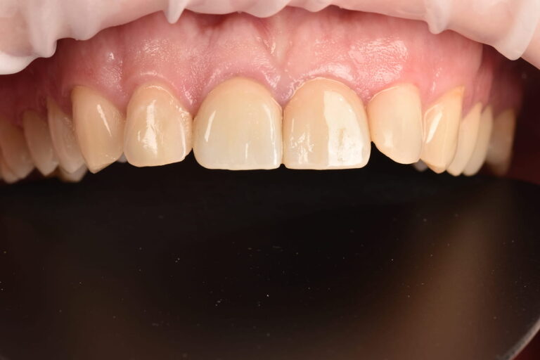Restoration of Esthetics and Function of the Anterior Teeth Using Crowns