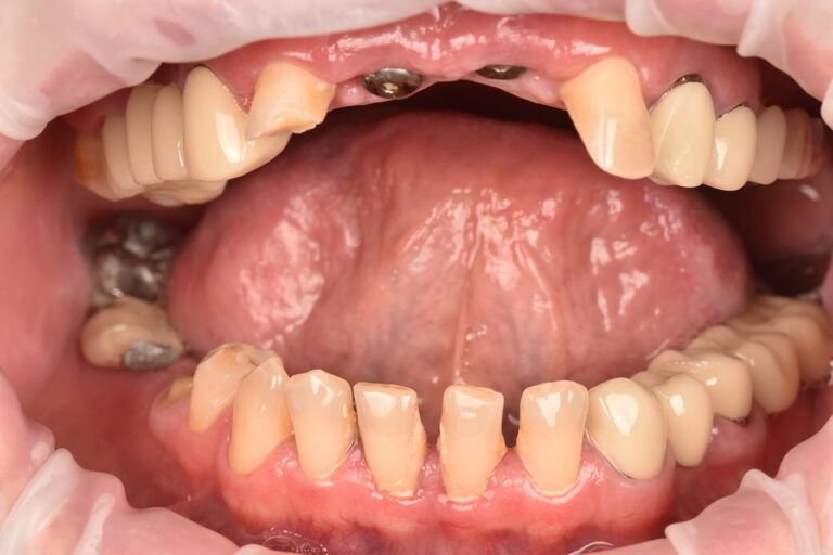 Prosthetic Rehabilitation of the Anterior Teeth Using Dental Implants and Zirconia Crowns