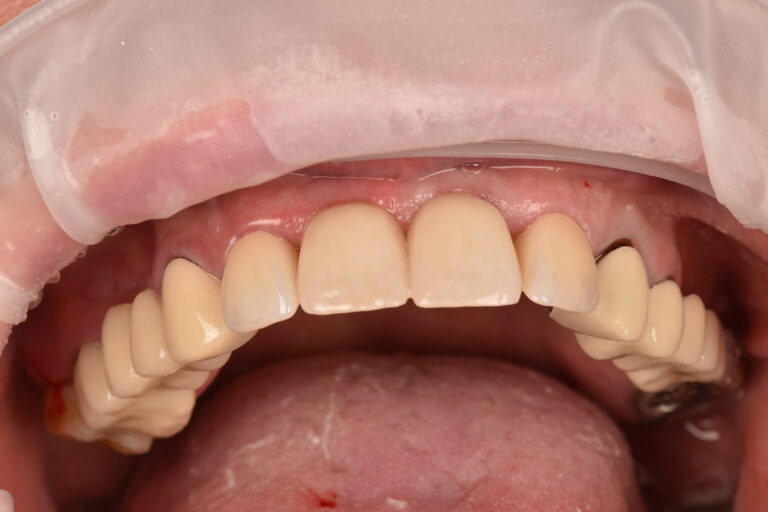 Prosthetic Rehabilitation of the Anterior Teeth Using Dental Implants and Zirconia Crowns