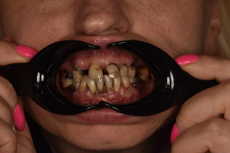Restoration of Masticatory Function and Smile Aesthetics Using the All-on-4 Concept