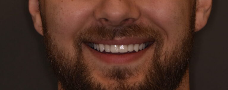Restoration of Anterior Teeth Aesthetics Using Ceramic Veneers