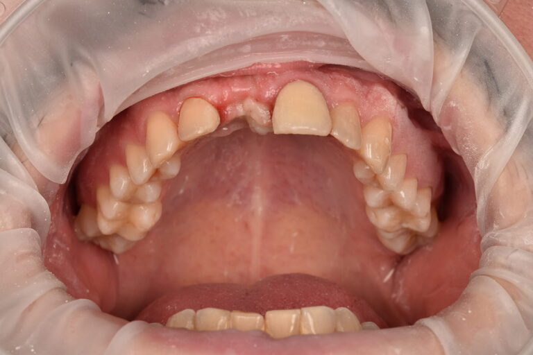Restoration of the Aesthetics and Function of an Anterior Tooth with Dental Implant Placement and a Zirconia Crown