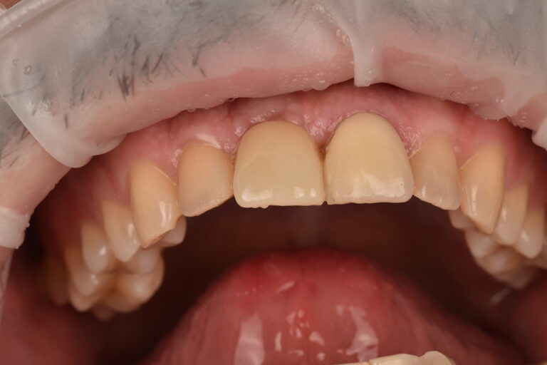 Restoration of the Aesthetics and Function of an Anterior Tooth with Dental Implant Placement and a Zirconia Crown