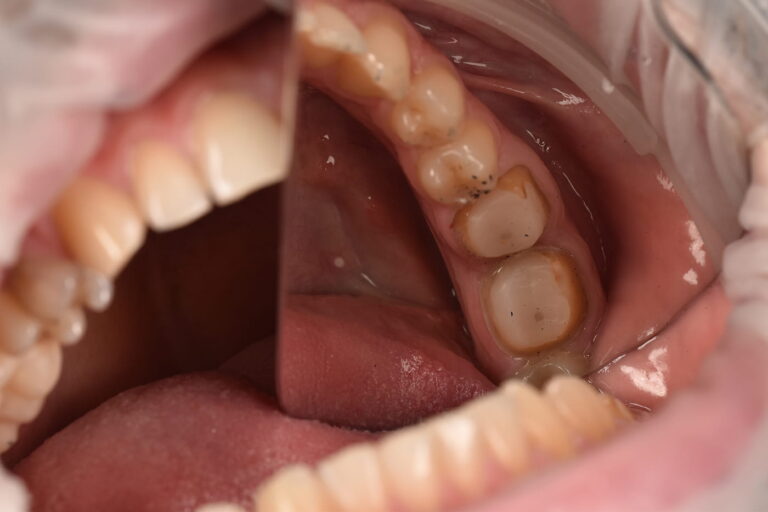 Prosthetic Rehabilitation of Posterior Teeth Using Zirconia Crowns