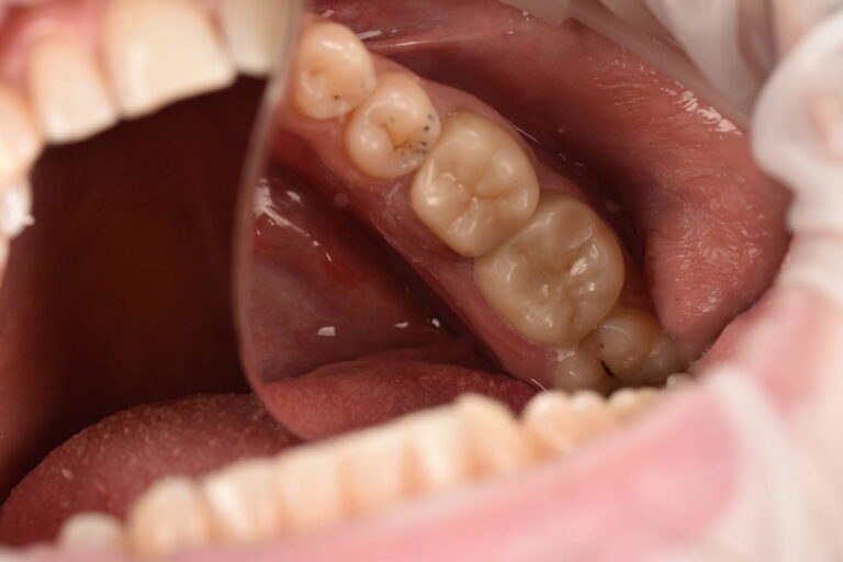 Prosthetic Rehabilitation of Posterior Teeth Using Zirconia Crowns
