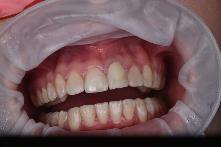 Restoration of an Anterior Tooth Using a Zirconia Crown