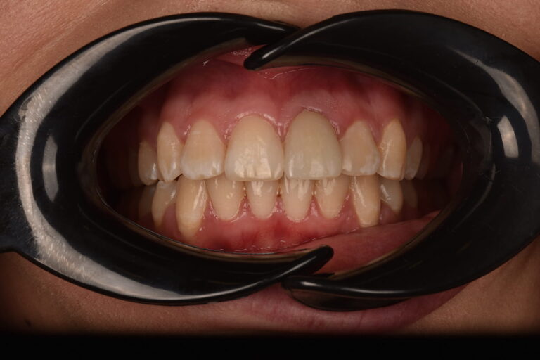 Restoration of an Anterior Tooth Using a Zirconia Crown