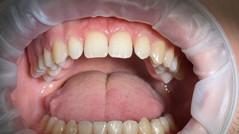 Aesthetic Restoration of Anterior Teeth Using Light-Cured Composite Materials
