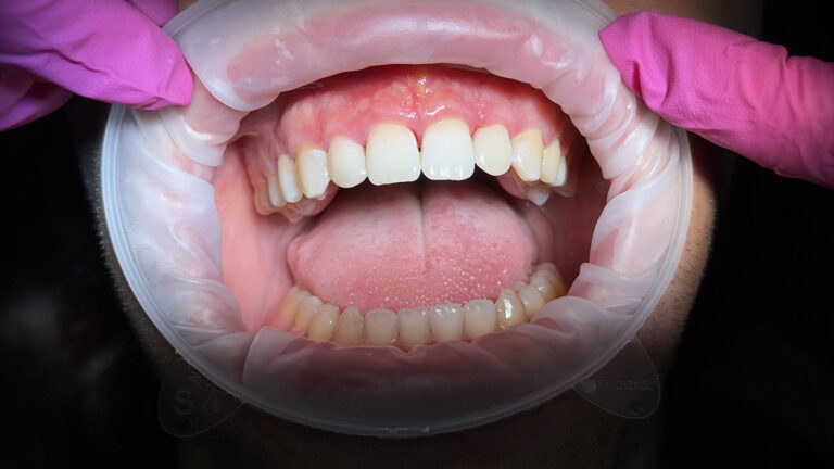Aesthetic Restoration of Anterior Teeth Using Light-Cured Composite Materials