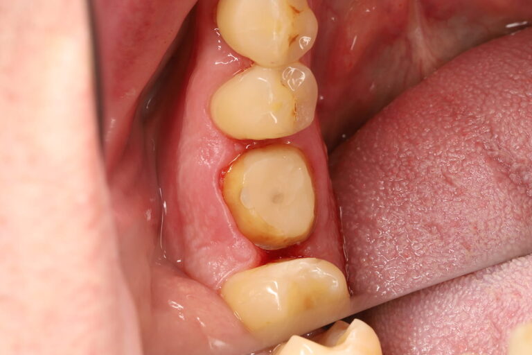 Endodontic Treatment Followed by Prosthetic Restoration with a Zirconia Crown
