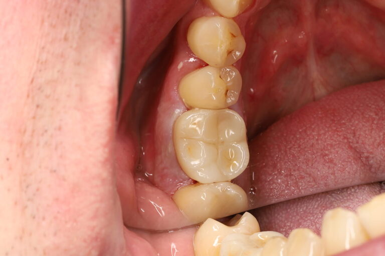 Endodontic Treatment Followed by Prosthetic Restoration with a Zirconia Crown