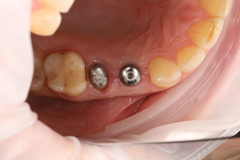 Restoration of Dental Aesthetics and Function Using an Implant and a Zirconia Crown