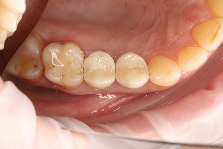 Restoration of Dental Aesthetics and Function Using an Implant and a Zirconia Crown