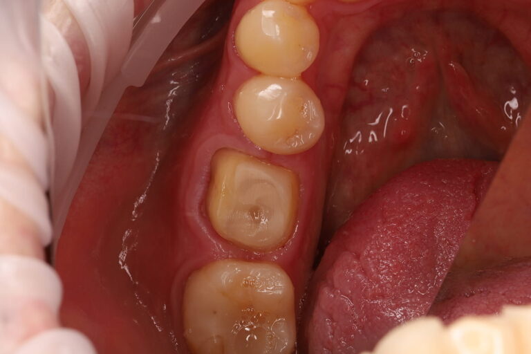 Restoration of a Severely Damaged Tooth with Endodontic Retreatment and a Zirconia Crown