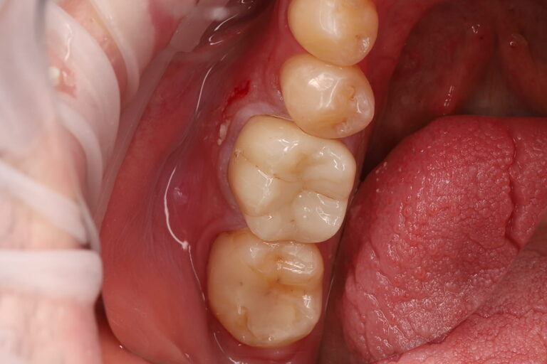 Restoration of a Severely Damaged Tooth with Endodontic Retreatment and a Zirconia Crown