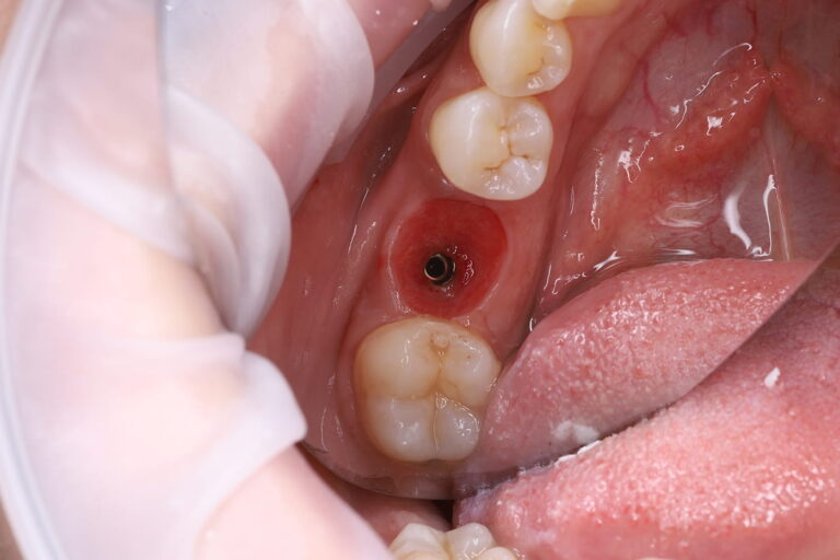 Restoration of a Posterior Tooth Using a Dental Implant and Crown