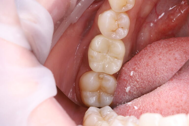 Restoration of a Posterior Tooth Using a Dental Implant and Crown