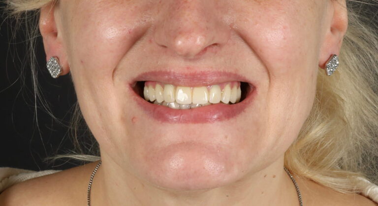 Restoration of Masticatory Function and Smile Aesthetics Using the All-on-4 Concept