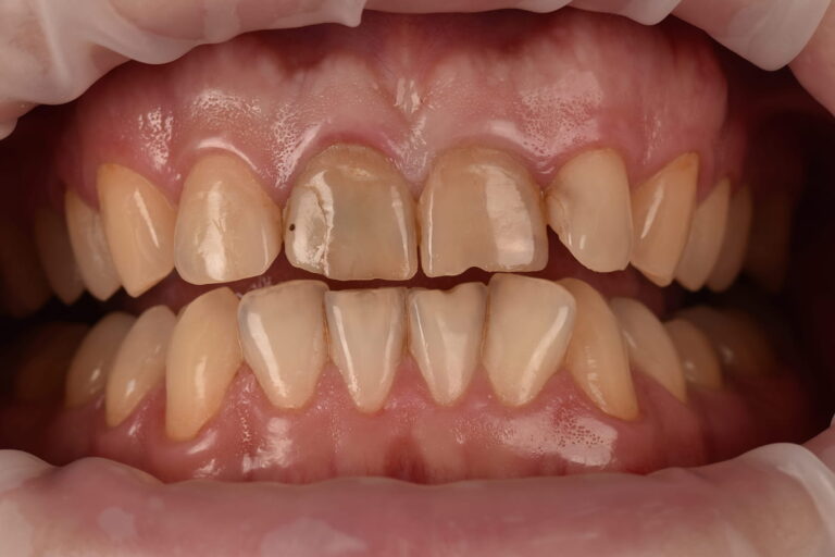 Restoration of Esthetics and Function of the Anterior Teeth Using Crowns
