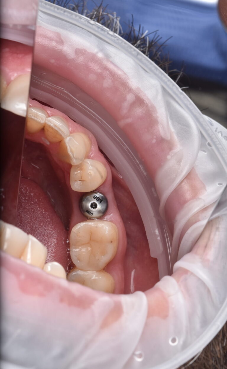 Placement of a Zirconia Crown on an Implant with Digital Planning