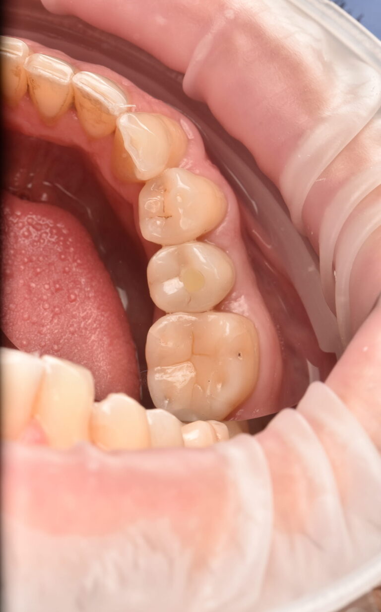 Placement of a Zirconia Crown on an Implant with Digital Planning
