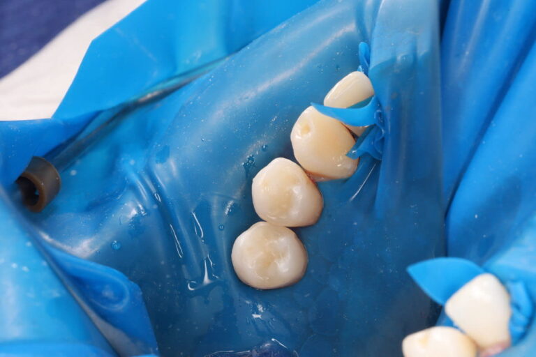 Aesthetic and Functional Restoration of Teeth 2.6–2.7 Using Light-Cured Composite Materials