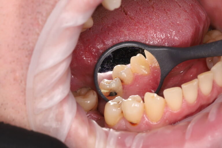 Aesthetic and Functional Restoration of Teeth 2.6–2.7 Using Light-Cured Composite Materials