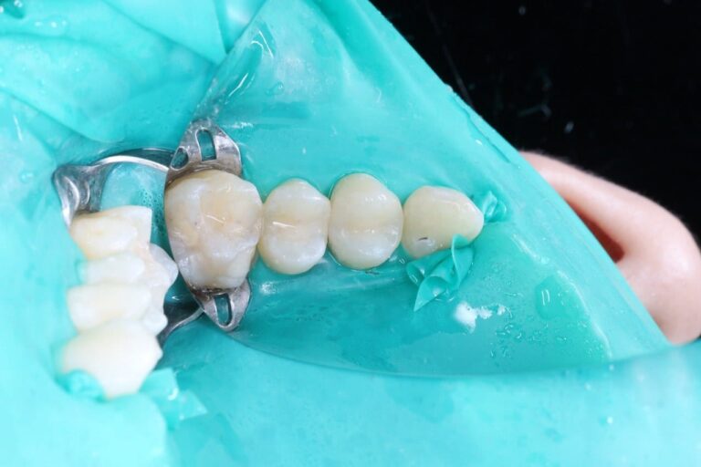 Caries Treatment and Aesthetic Restoration of Teeth