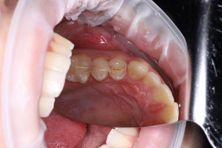 Caries Treatment and Aesthetic Restoration of Teeth