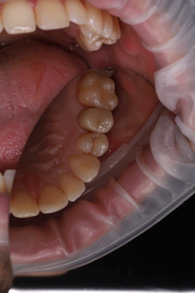 Aesthetic Restoration of Tooth 24 Using a Light-Cured Composite Restoration
