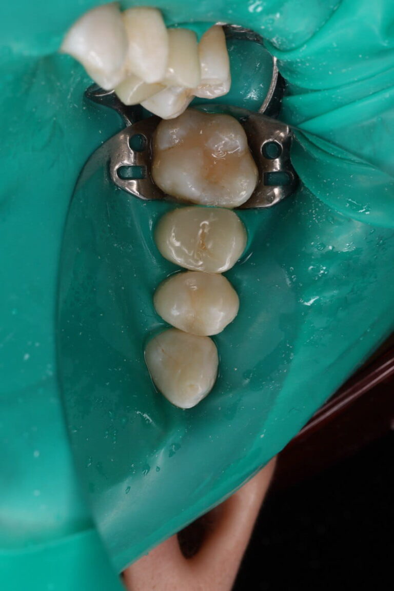 Aesthetic Restoration of Tooth 24 Using a Light-Cured Composite Restoration