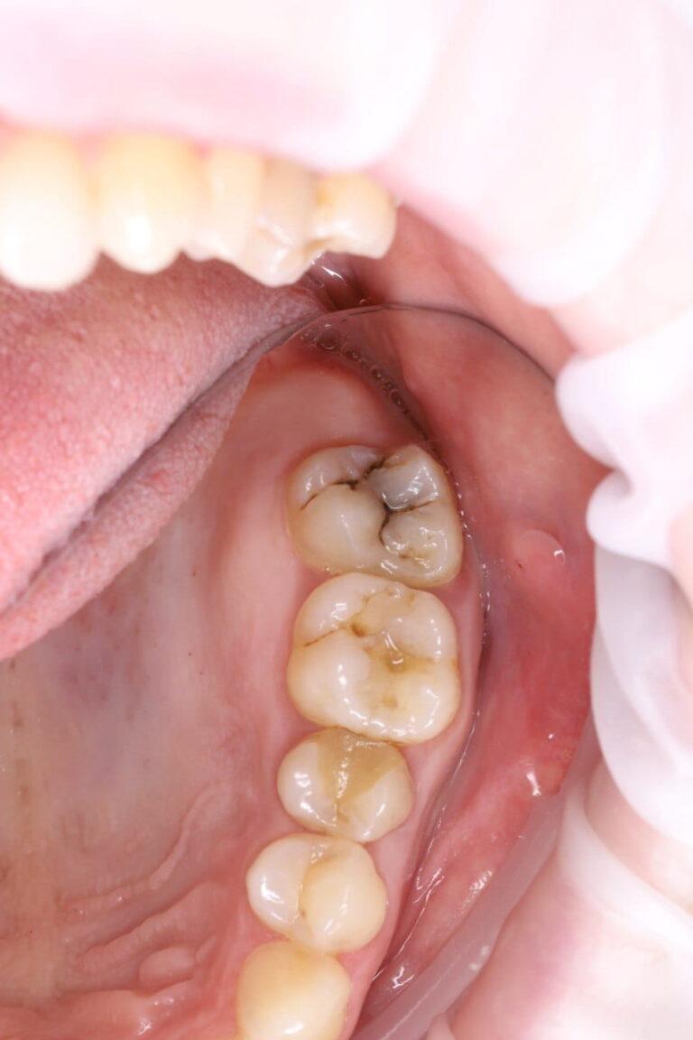 Caries Treatment and Aesthetic Restoration of Teeth Using Light-Cured Composite Materials