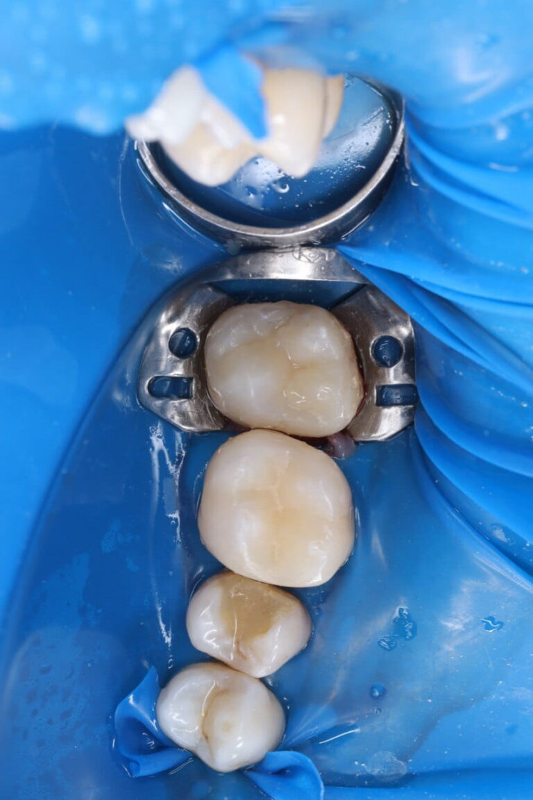 Caries Treatment and Aesthetic Restoration of Teeth Using Light-Cured Composite Materials