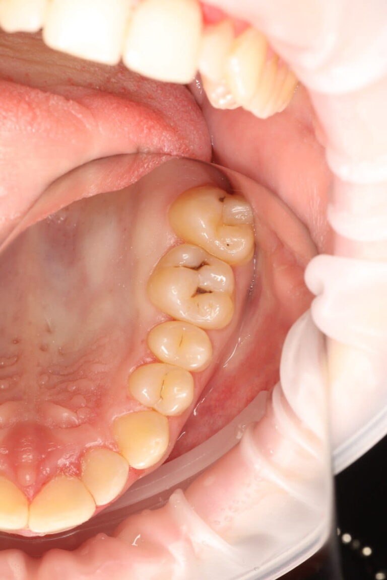 Restoration of the Anatomical Form of Mandibular Teeth Using Composite Restorations