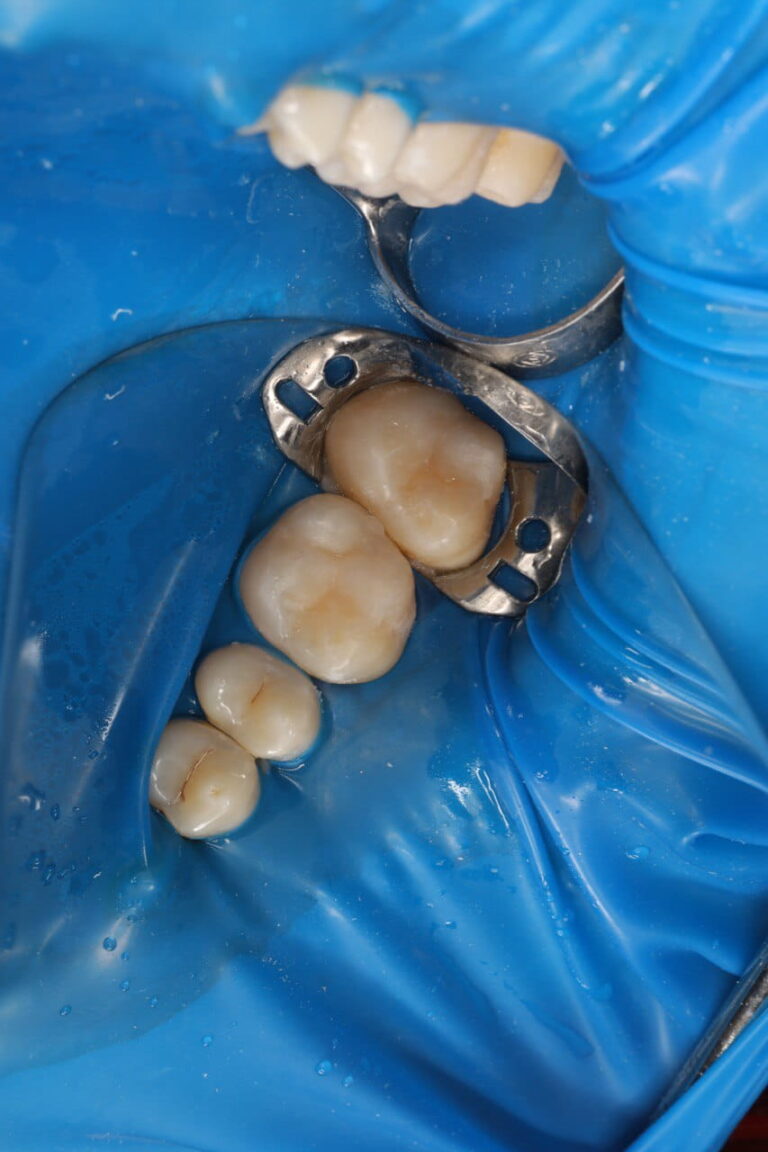 Restoration of the Anatomical Form of Mandibular Teeth Using Composite Restorations
