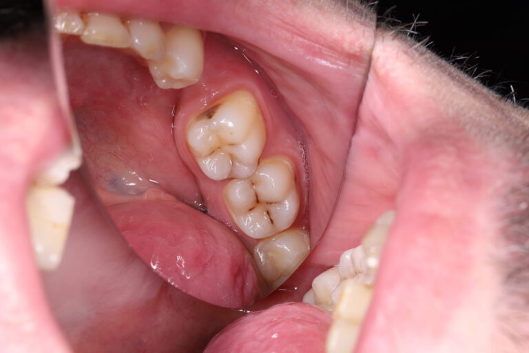 Aesthetic and Functional Restoration of Tooth 24 Using Light-Cured Composite Materials