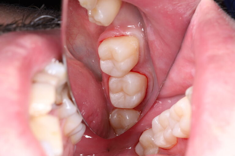 Aesthetic and Functional Restoration of Tooth 24 Using Light-Cured Composite Materials