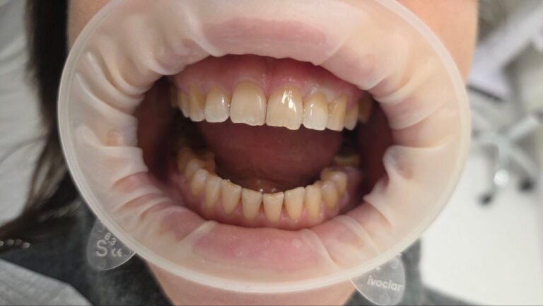 Restoration of Tooth 22 with a Zirconia Post-and-Core and Zirconia Crown