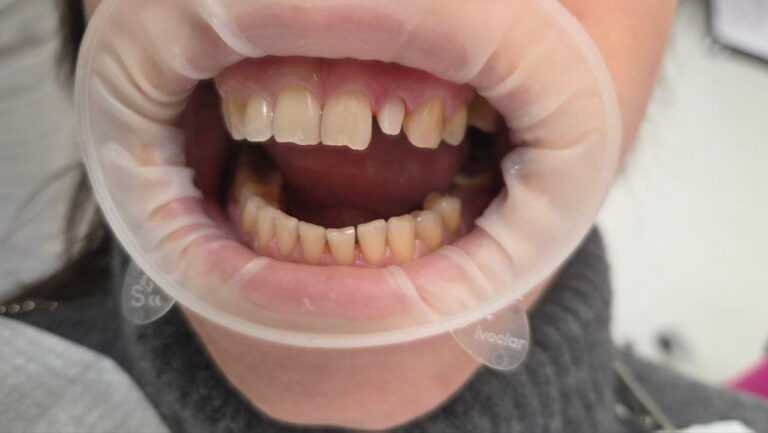 Restoration of Tooth 22 with a Zirconia Post-and-Core and Zirconia Crown