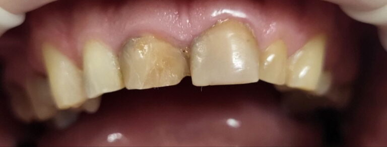 Aesthetic Rehabilitation of the Anterior Dentition with E.max Crowns
