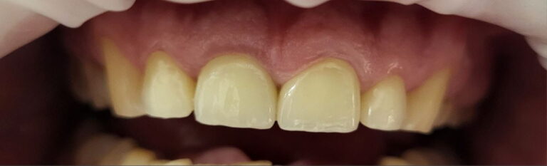 Aesthetic Rehabilitation of the Anterior Dentition with E.max Crowns