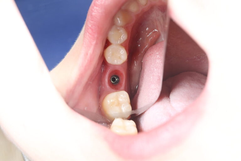 Immediate Implant Placement Followed by Prosthetic Restoration with a Zirconia Crown