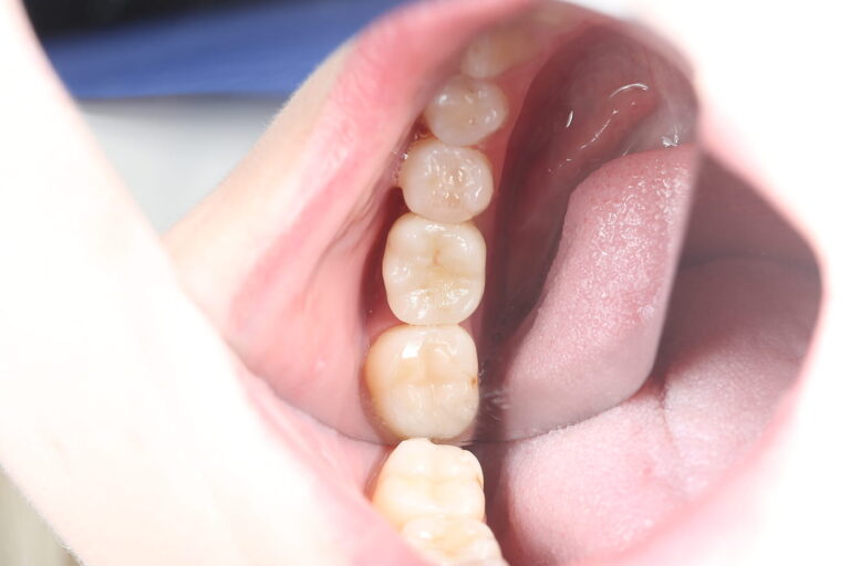 Immediate Implant Placement Followed by Prosthetic Restoration with a Zirconia Crown