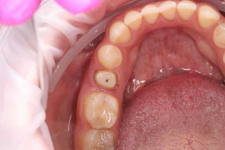 Endodontic Retreatment and Restoration of a Severely Damaged Tooth with a Zirconia Crown