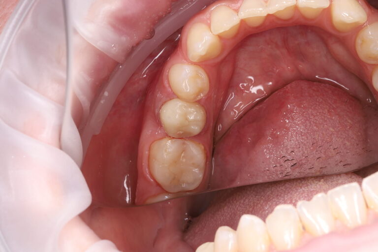 Endodontic Retreatment and Restoration of a Severely Damaged Tooth with a Zirconia Crown