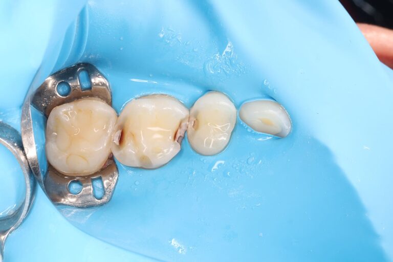 Aesthetic and functional restoration of teeth 26 and 25 with composite material.