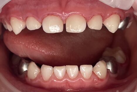 Comprehensive treatment of primary teeth under general anesthesia