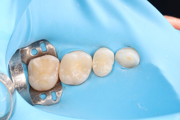 Aesthetic and functional restoration of teeth 26 and 25 with composite material.