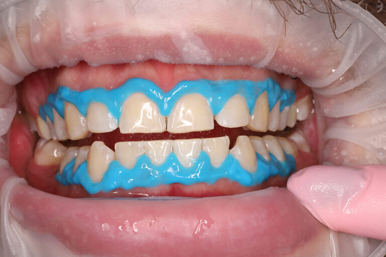 Professional tooth whitening using the Beyond system.