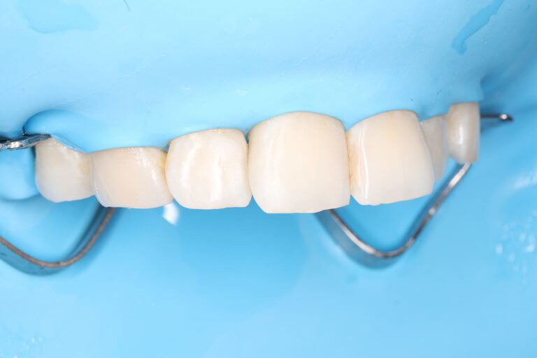 Treatment of secondary caries prior to orthodontic treatment.